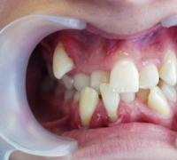 Симптомы и лечение гипердонтии – сверхкомплектных зубов Несколько рядов зубов у человека болезнь